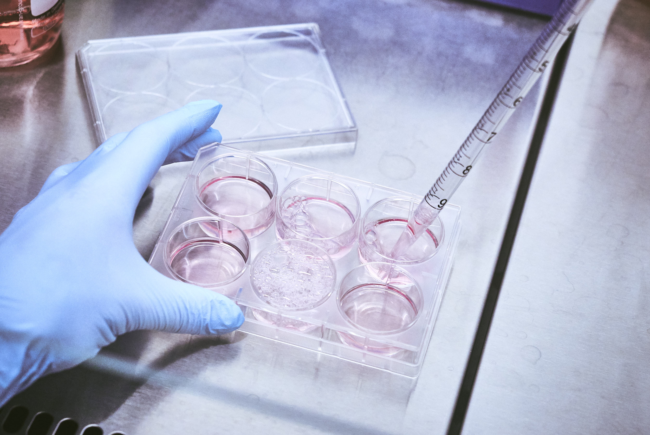 Prostatakarzinom: „Liquid Biopsies“ ermöglichen nicht-invasive Diagnostik von metastasierten Karzinomen